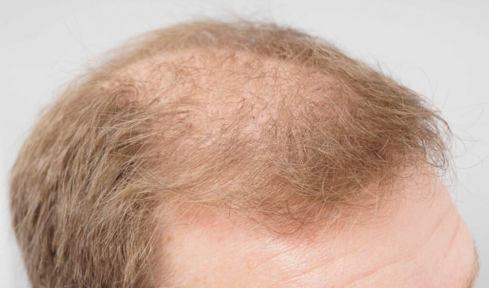 FUE Hair Transplant - Farjo Hair Institute7.jpg