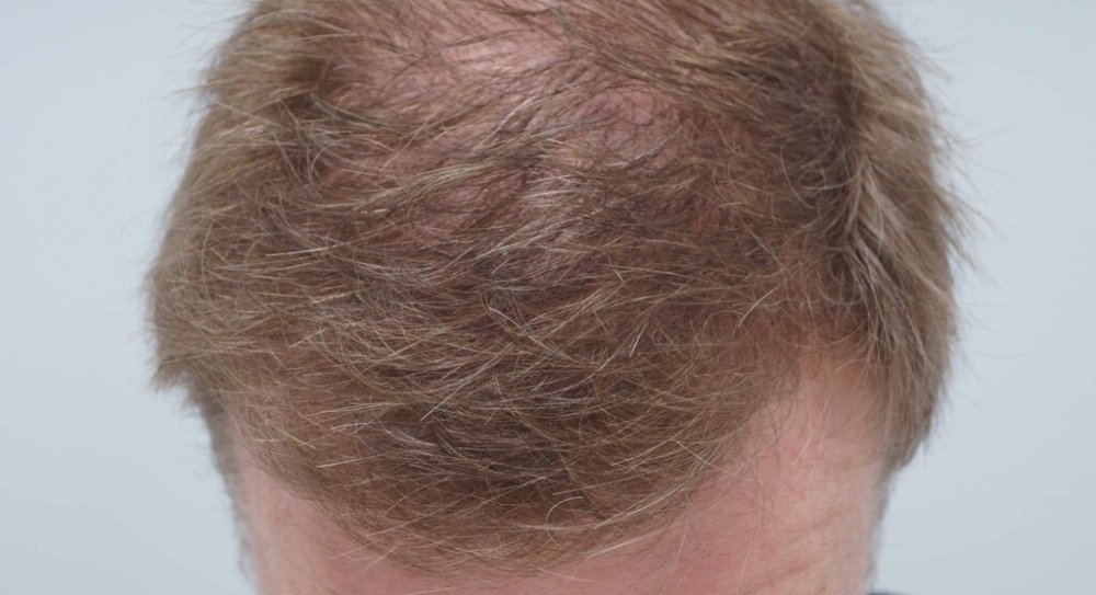 FUE Hair Transplant - Farjo Hair Institute8.jpg