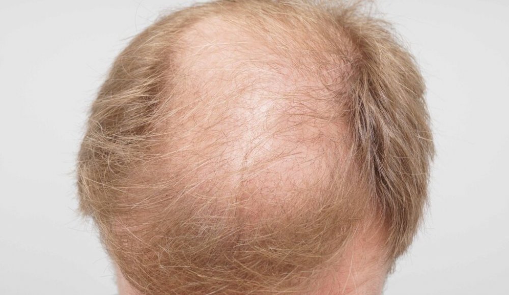 FUE Hair Transplant - Farjo Hair Institute9.jpg
