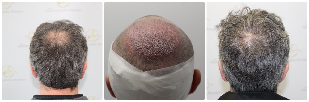 fue-hair-transplant-glasgow.jpg