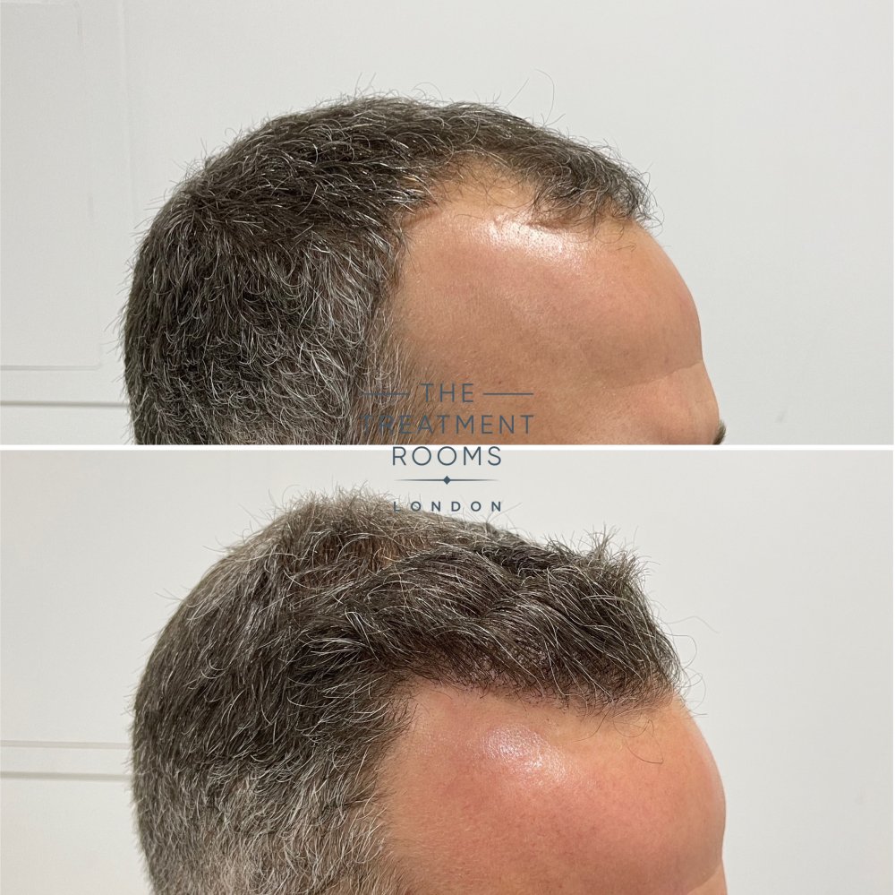 fue hair transplant london 1788 grafts hairline result.jpg