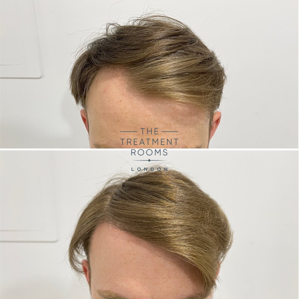 fue hair transplant london result 1700 grafts.jpg