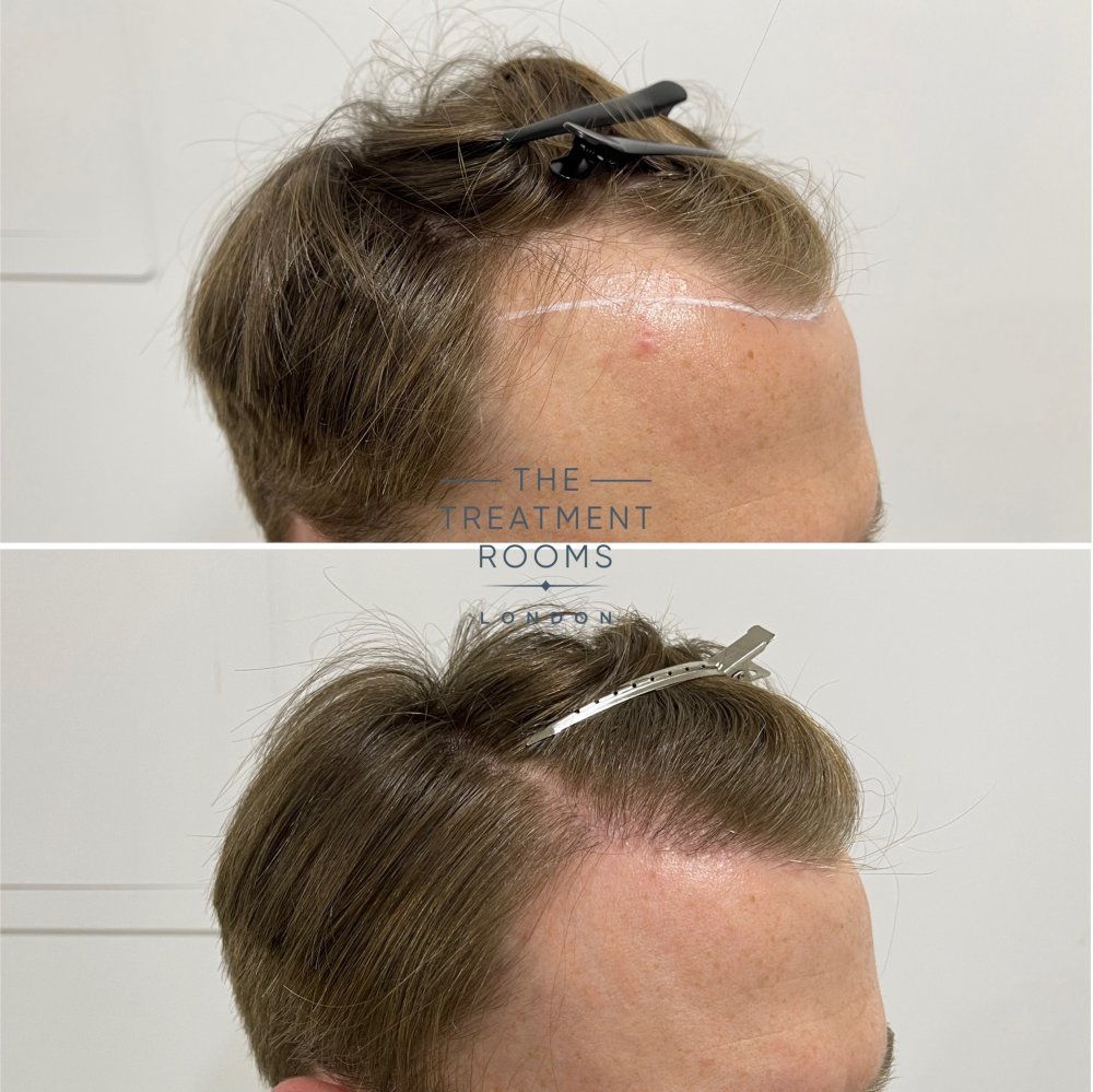 fue hair transplant result 1700 grafts.jpg