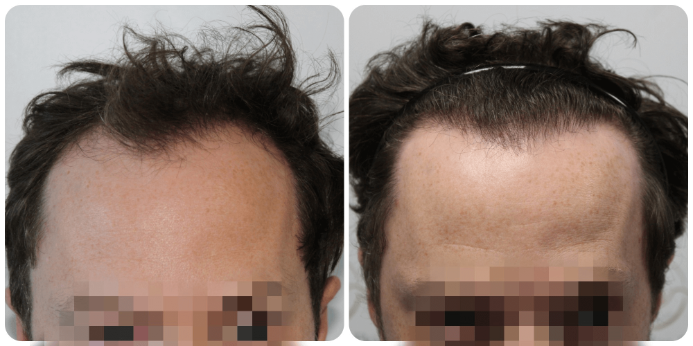 fue-hair-transplant-scotland-uk.png