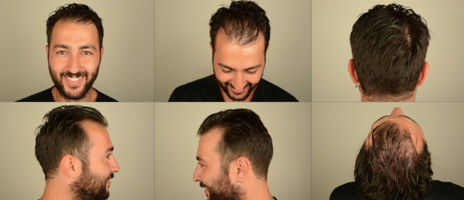 Fue hair transplant smed..jpg