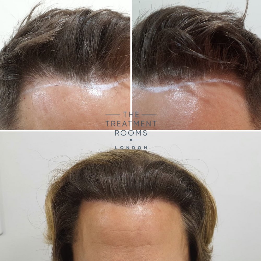 FUE hair transplant surgery fix before and after.jpg