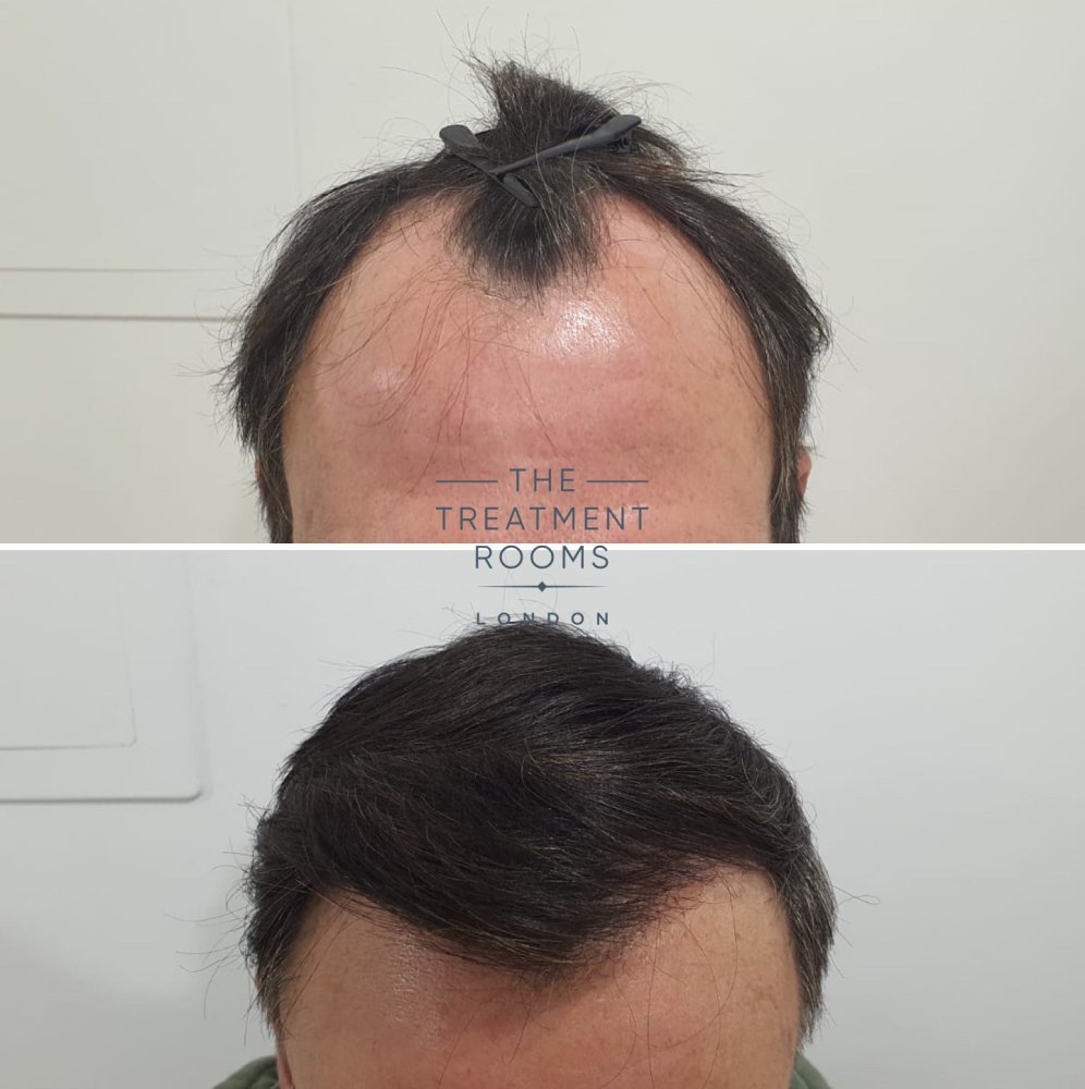 FUE hair transplant The Treatment Rooms London.jpg