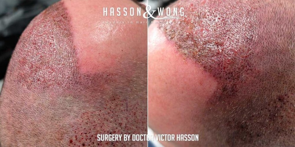FUE Hair Transplant with Dr. Victor Hasson15.jpg
