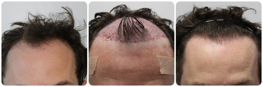 fue-procedure-results.jpg