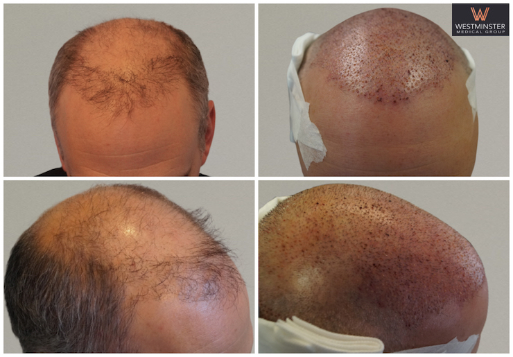FUE Repair Post.jpg