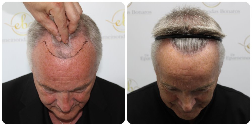 fue-surgery-by-dr-bonaros-glasgow.jpg