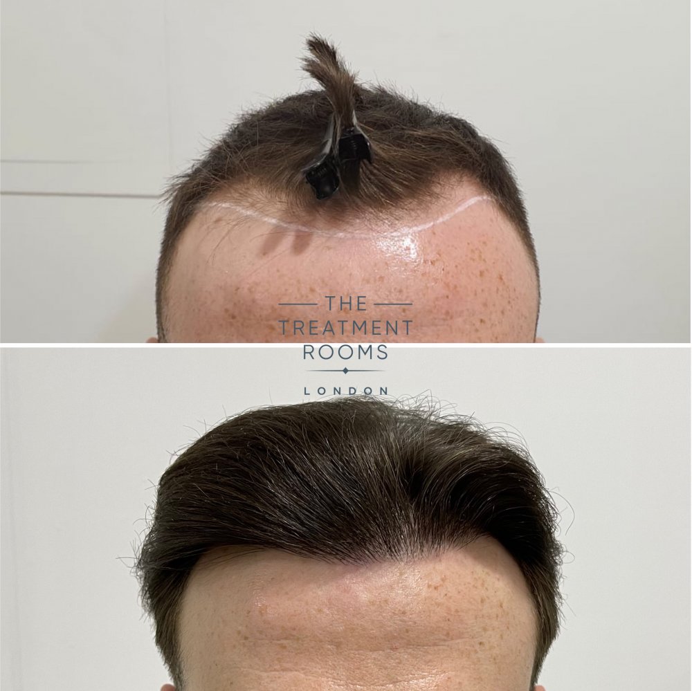 FUE surgery Receding hairline.jpg