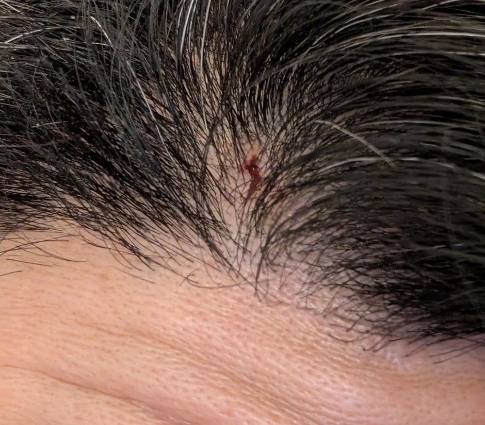 gash-on-head-from-injury-can-it-cause-permanent-hair-loss-v0-7lgtebvdj23f1.jpg
