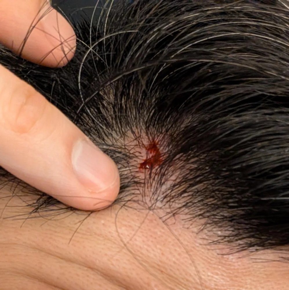 gash-on-head-from-injury-can-it-cause-permanent-hair-loss-v0-9gm7y3udj23f1.jpg