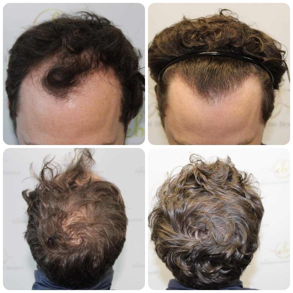 glasgow-hair-transplant.jpg