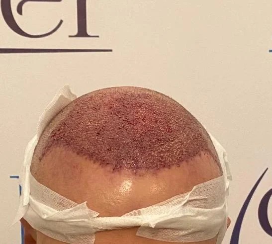 graft placement jagged hairline dr bicer.jpg