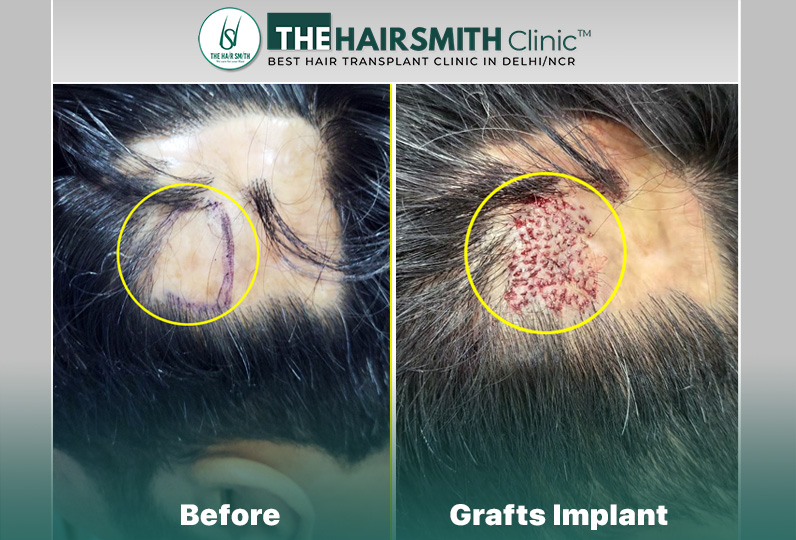 Grafts Implant - Hairsmith Hair Transplant.jpg