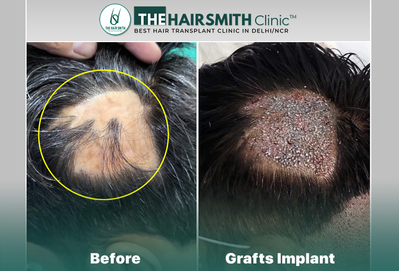 Grafts Implant - urfue technique - hairsmith hair transplant.jpg