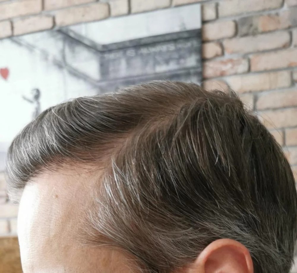 grown out hairline dr Bicer.jpg
