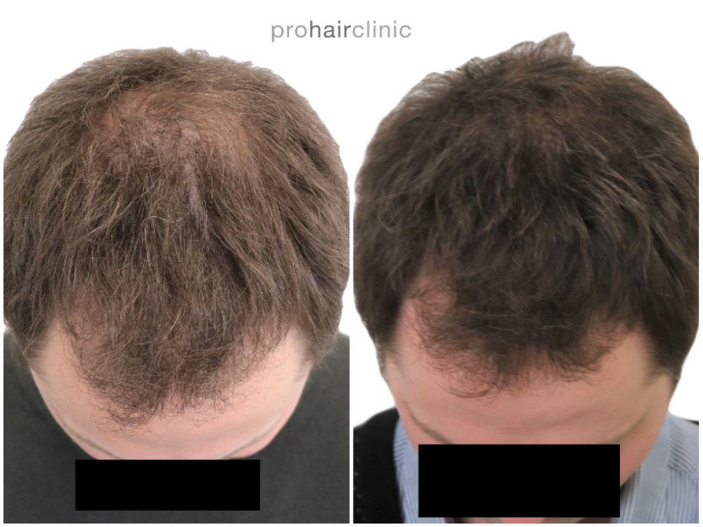 hair boost top view prohairclinic logo.jpg