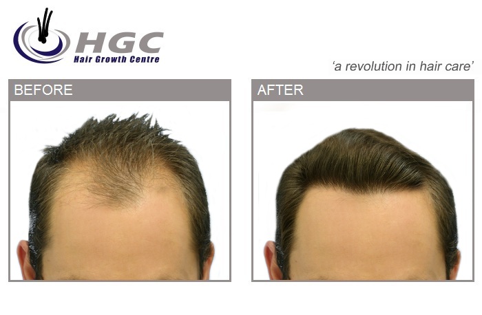 Hair Growth centre stole this hair transplant picture from Hassson and Wong.jpg