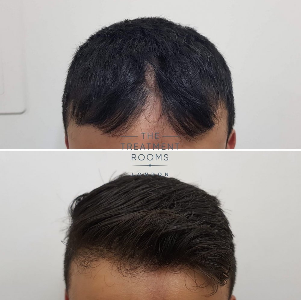 Hair Transplant 1.jpg