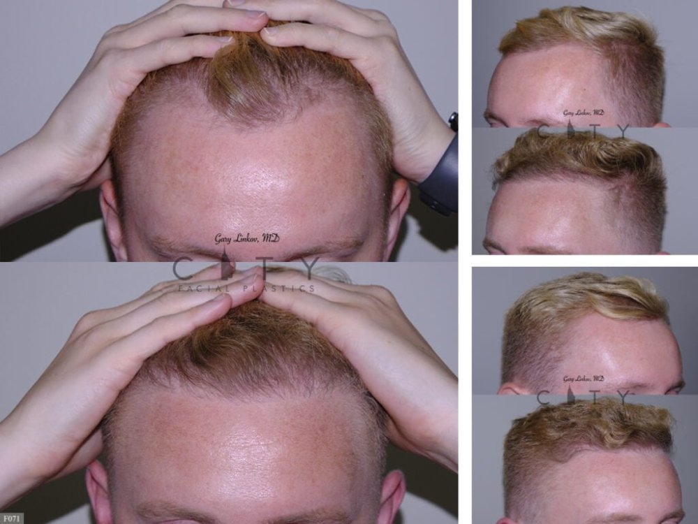 Hair-Transplant 1.jpg