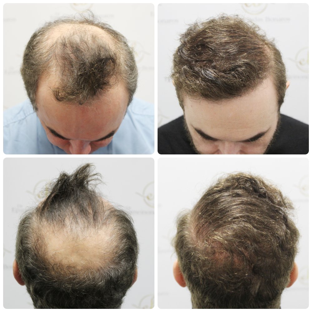 hair-transplant-12-months-result-glasgow-dr-bonaros (18).jpg