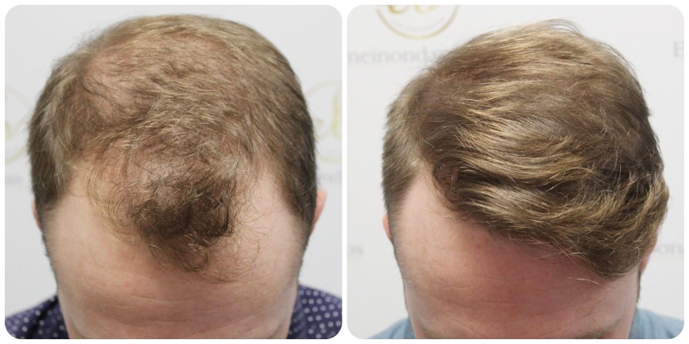 hair-transplant-12-months-result-glasgow-dr-bonaros (2).jpg