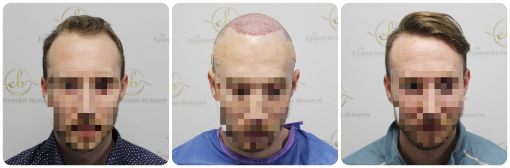 hair-transplant-12-months-result-glasgow-dr-bonaros (20) (1).jpg