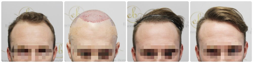 hair-transplant-12-months-result-glasgow-dr-bonaros (21).jpg