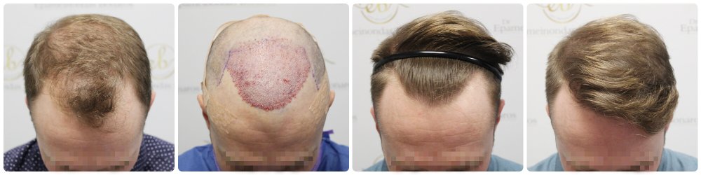 hair-transplant-12-months-result-glasgow-dr-bonaros (22).jpg