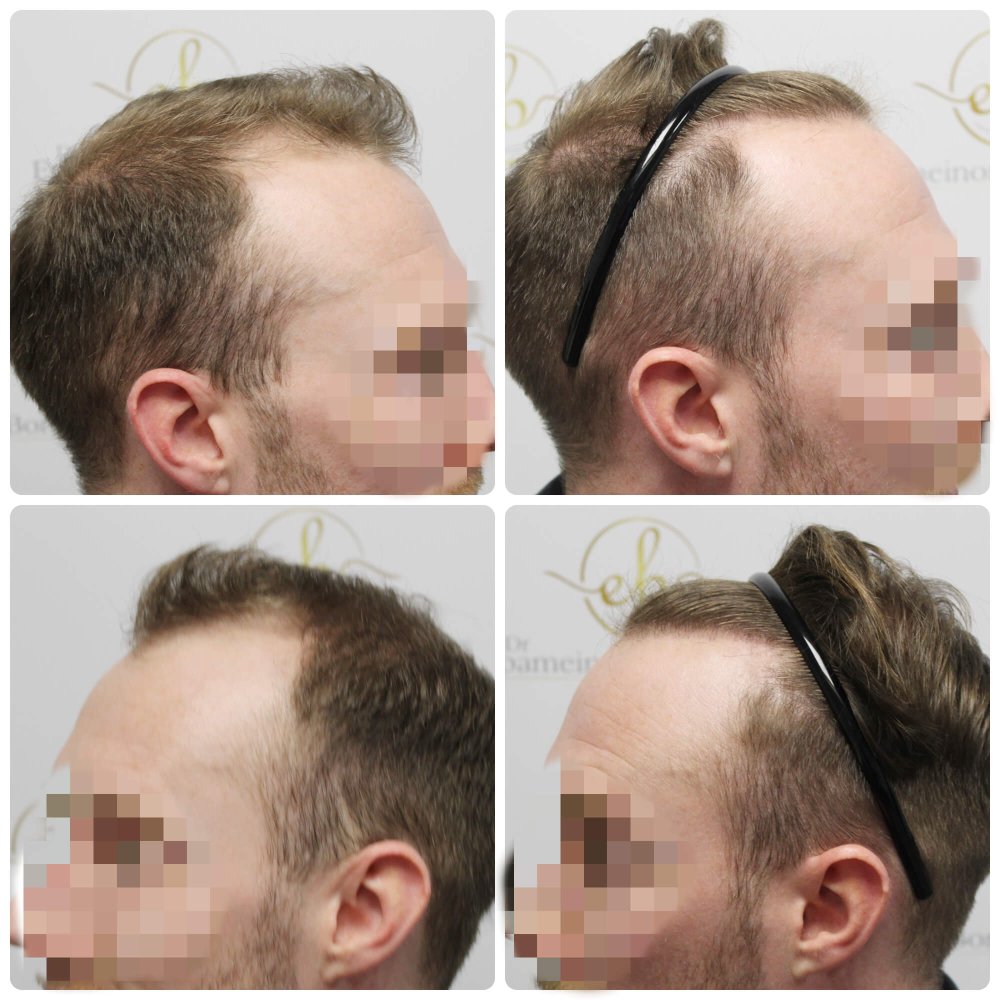 hair-transplant-12-months-result-glasgow-dr-bonaros (23).jpg