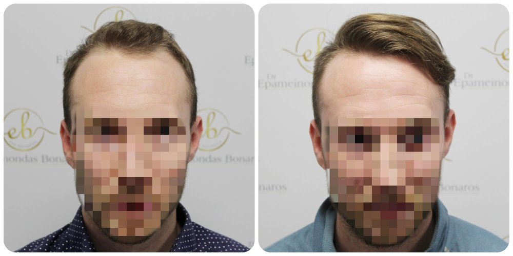 hair-transplant-12-months-result-glasgow-dr-bonaros (24).jpg