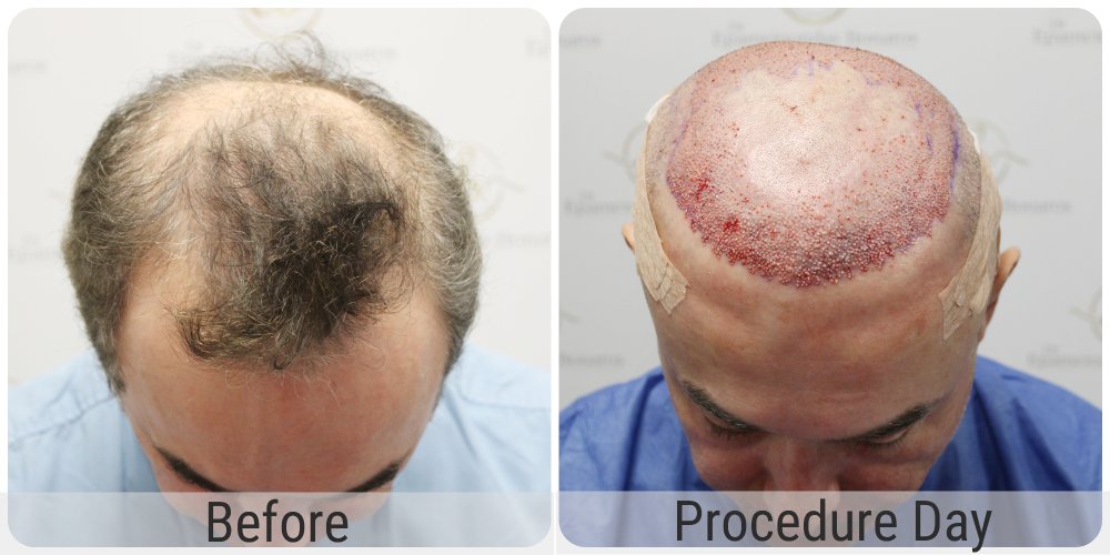 hair-transplant-12-months-result-glasgow-dr-bonaros (32) (1).jpg