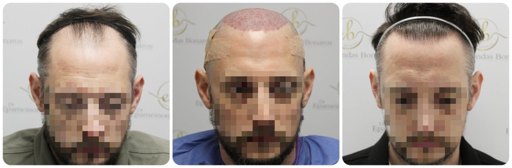 hair-transplant-12-months-result-glasgow-dr-bonaros (48).jpg