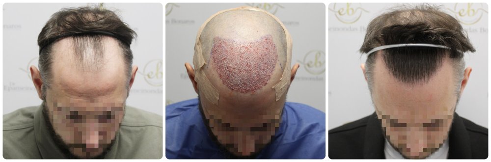 hair-transplant-12-months-result-glasgow-dr-bonaros (49).jpg