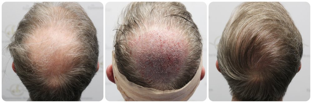 hair-transplant-12-months-result-glasgow-dr-bonaros (54) (1).jpg