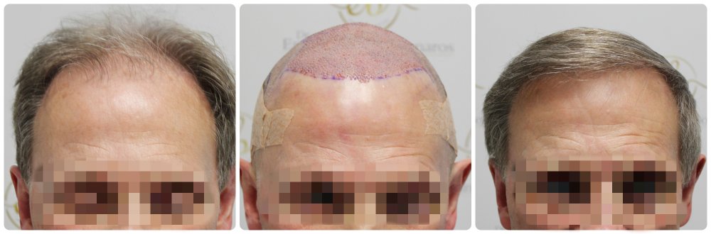 hair-transplant-12-months-result-glasgow-dr-bonaros (55) (1).jpg