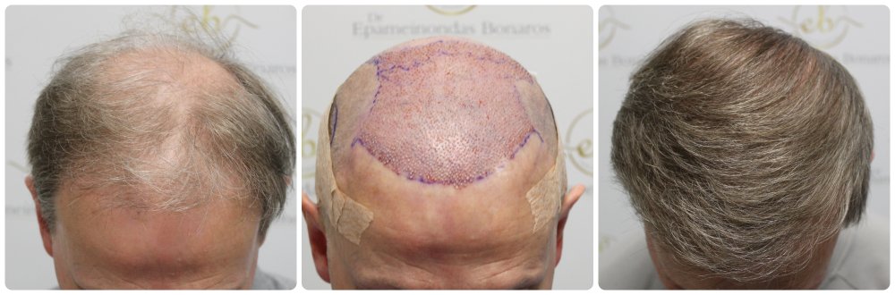 hair-transplant-12-months-result-glasgow-dr-bonaros (56) (1).jpg