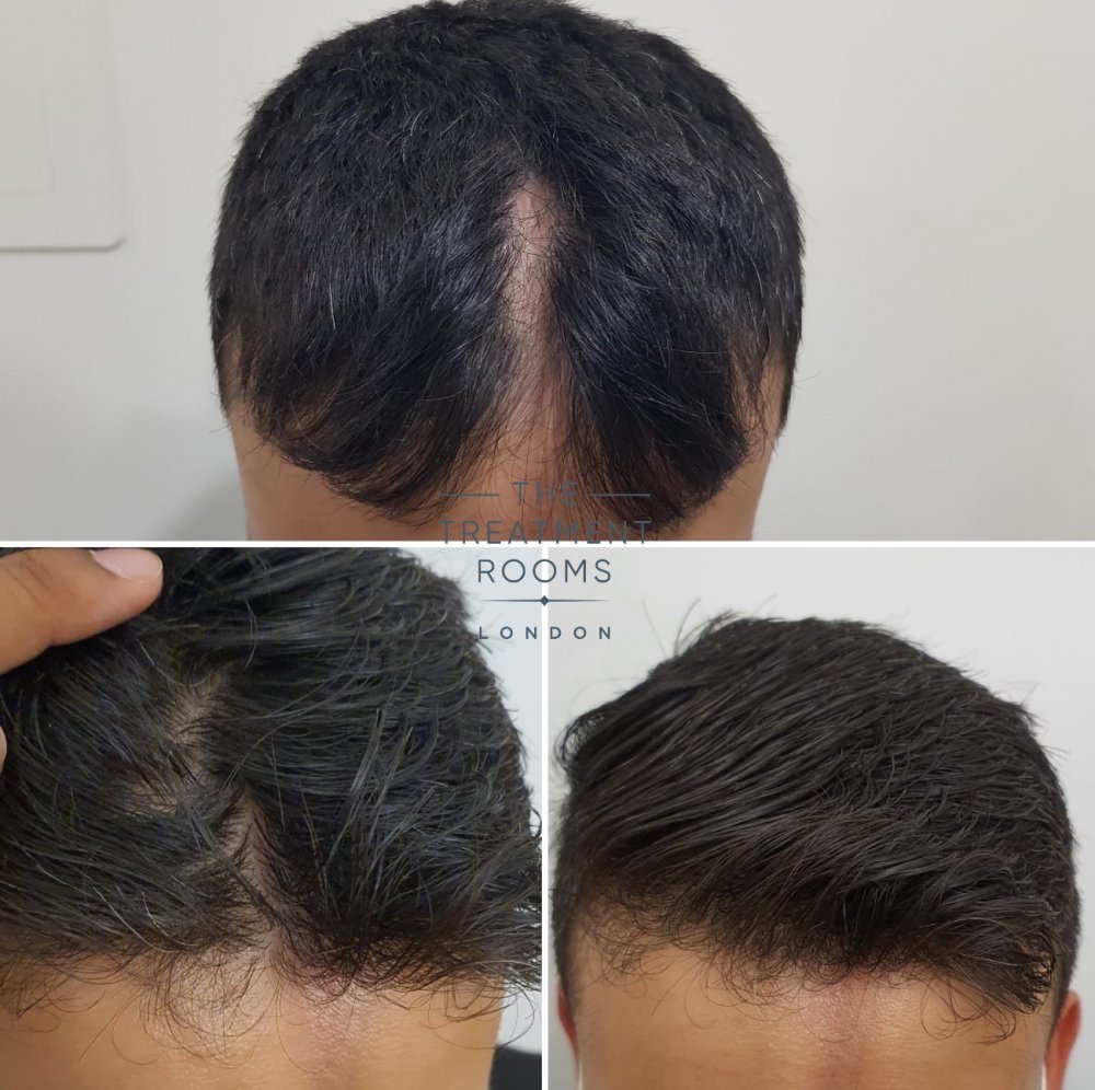 hair transplant 2.jpg