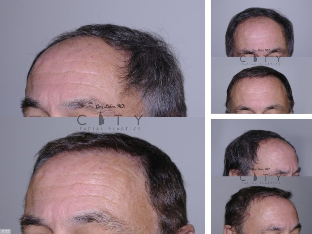Hair-Transplant 2.jpg