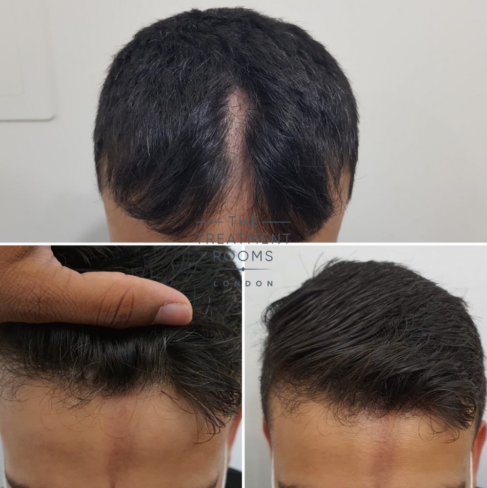 hair transplant 3.jpg