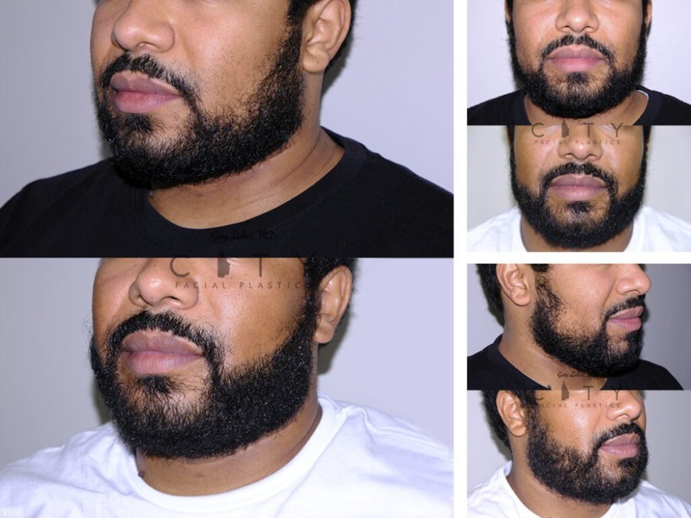 Hair-Transplant 3.jpg