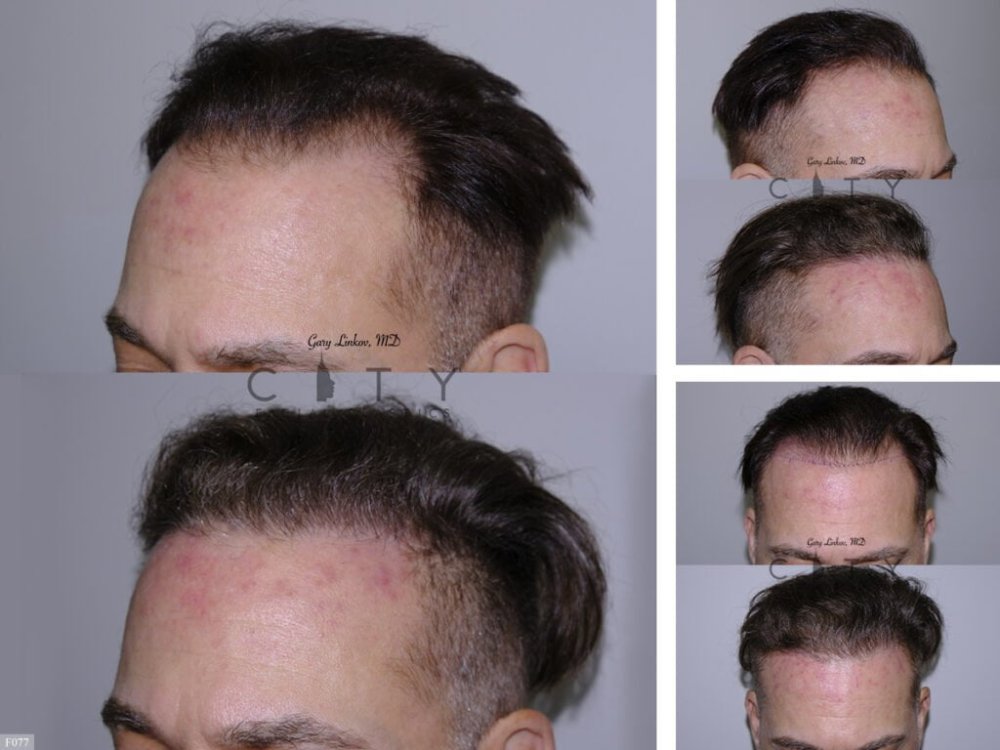Hair-Transplant 4.jpg