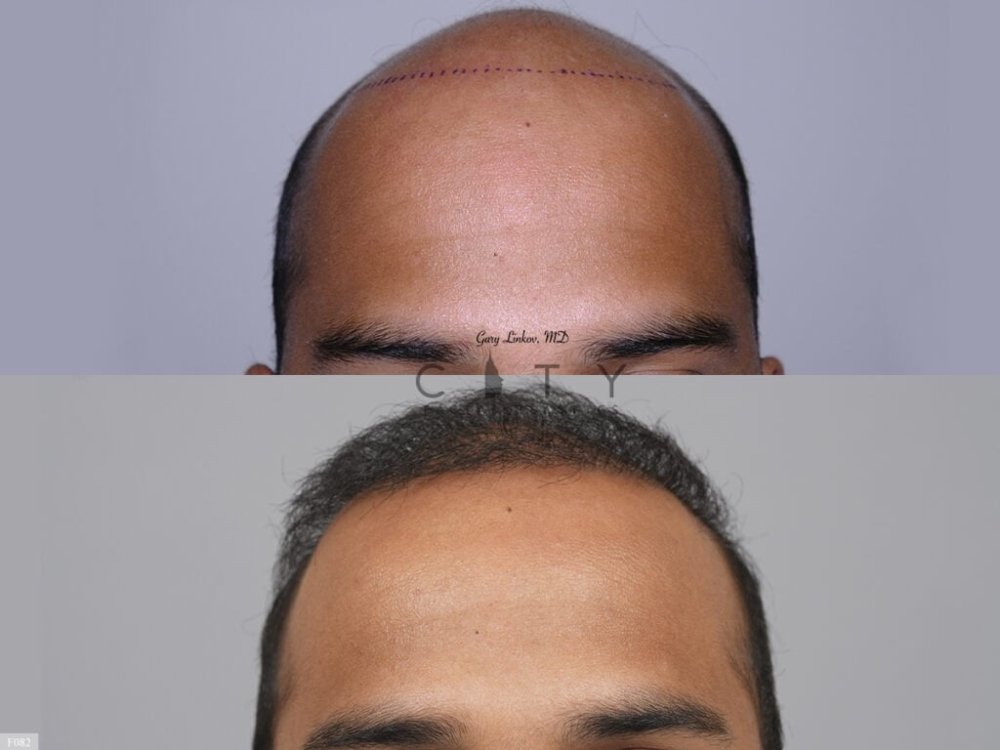 Hair-Transplant 5.jpg