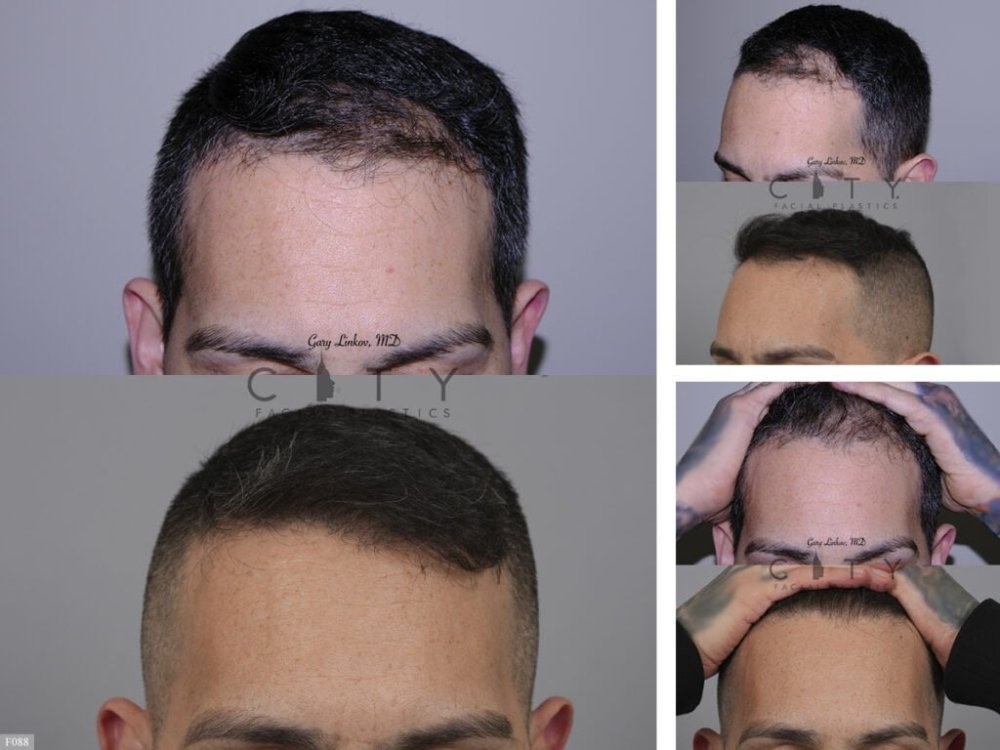 Hair-Transplant 7.jpg