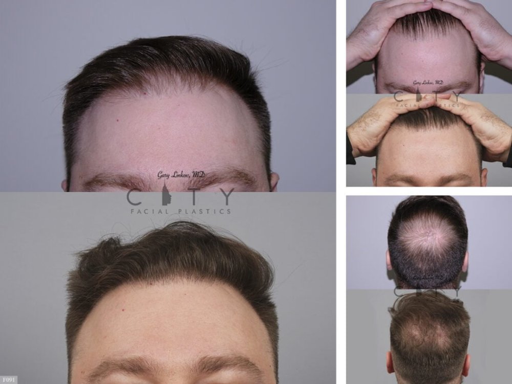 Hair-Transplant 8.jpg