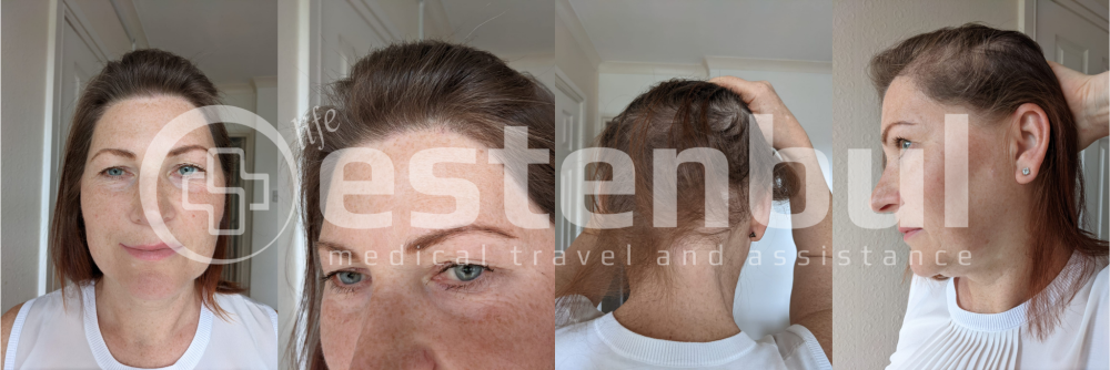hair transplant after.png