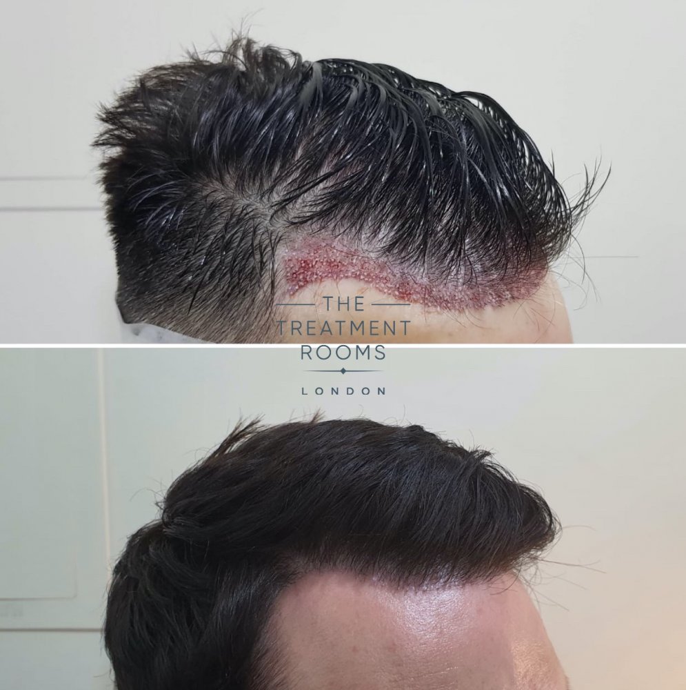 Hair Transplant Before and After Straight hair.jpg